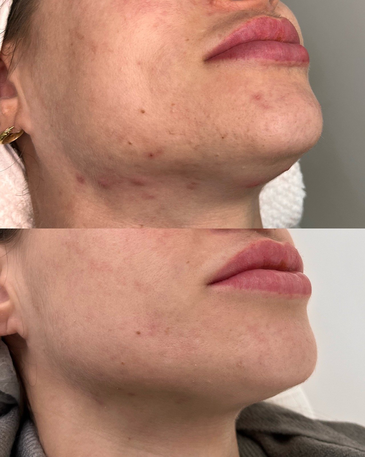 Antes e depois - Tratamento de acne