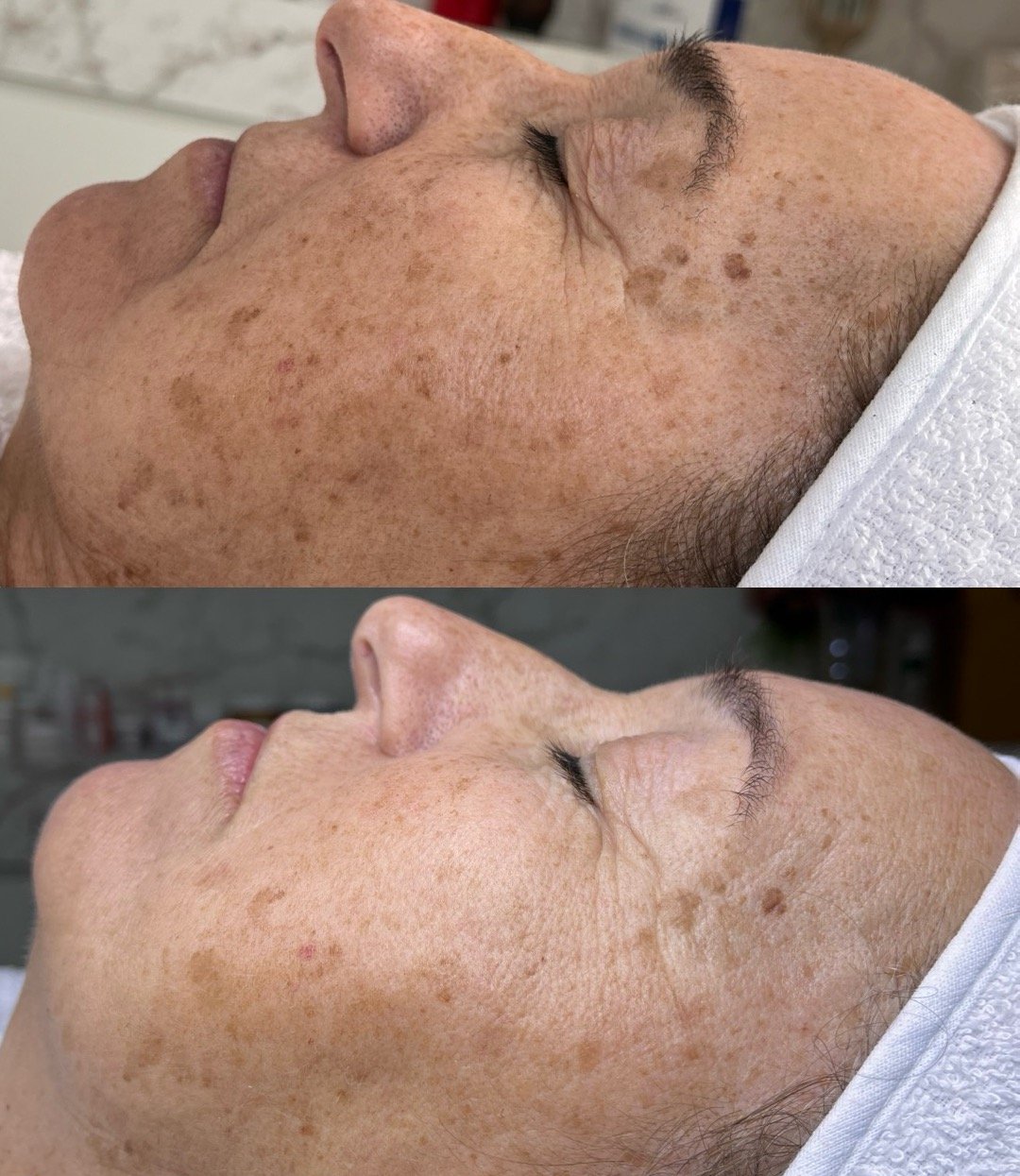 Antes e depois - Protocolo Intense Repair