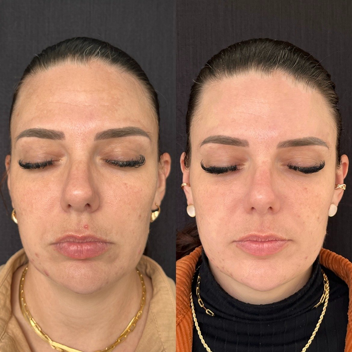 Antes e depois - Protocolo para melasma