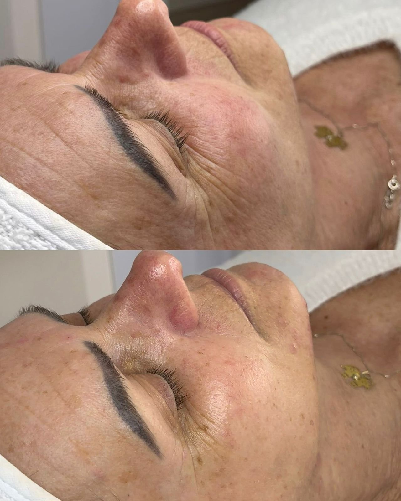 Antes e depois - Limpeza de pele com peeling químico
