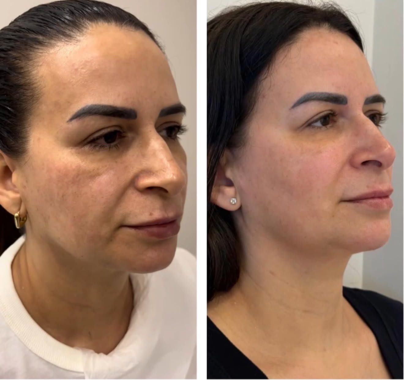 Harmonização Full Face - Caso 3