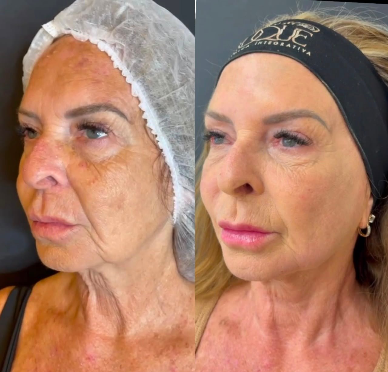 Protocolo Renovar Face - Caso 2