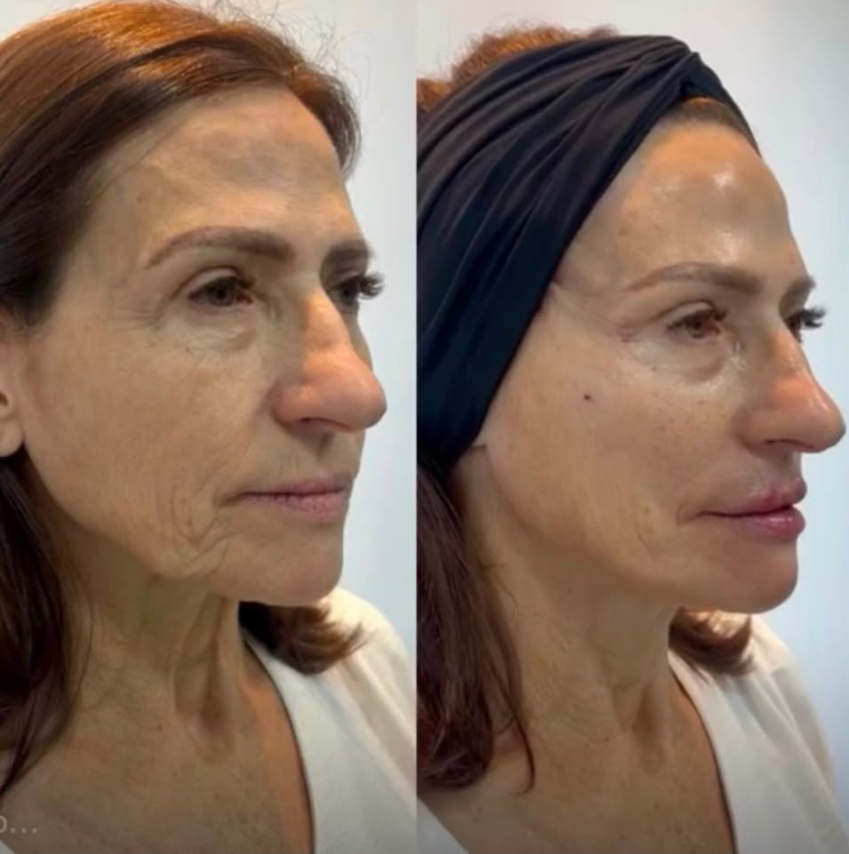 Protocolo Renovar Face - Caso 1