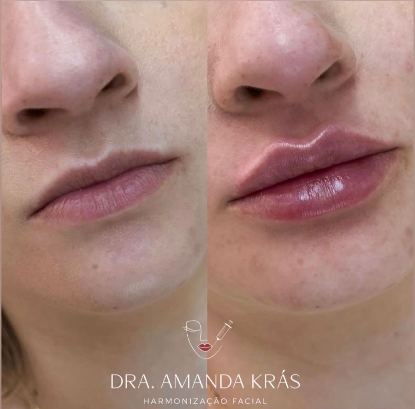 Preenchimento Labial Premium - Caso 3