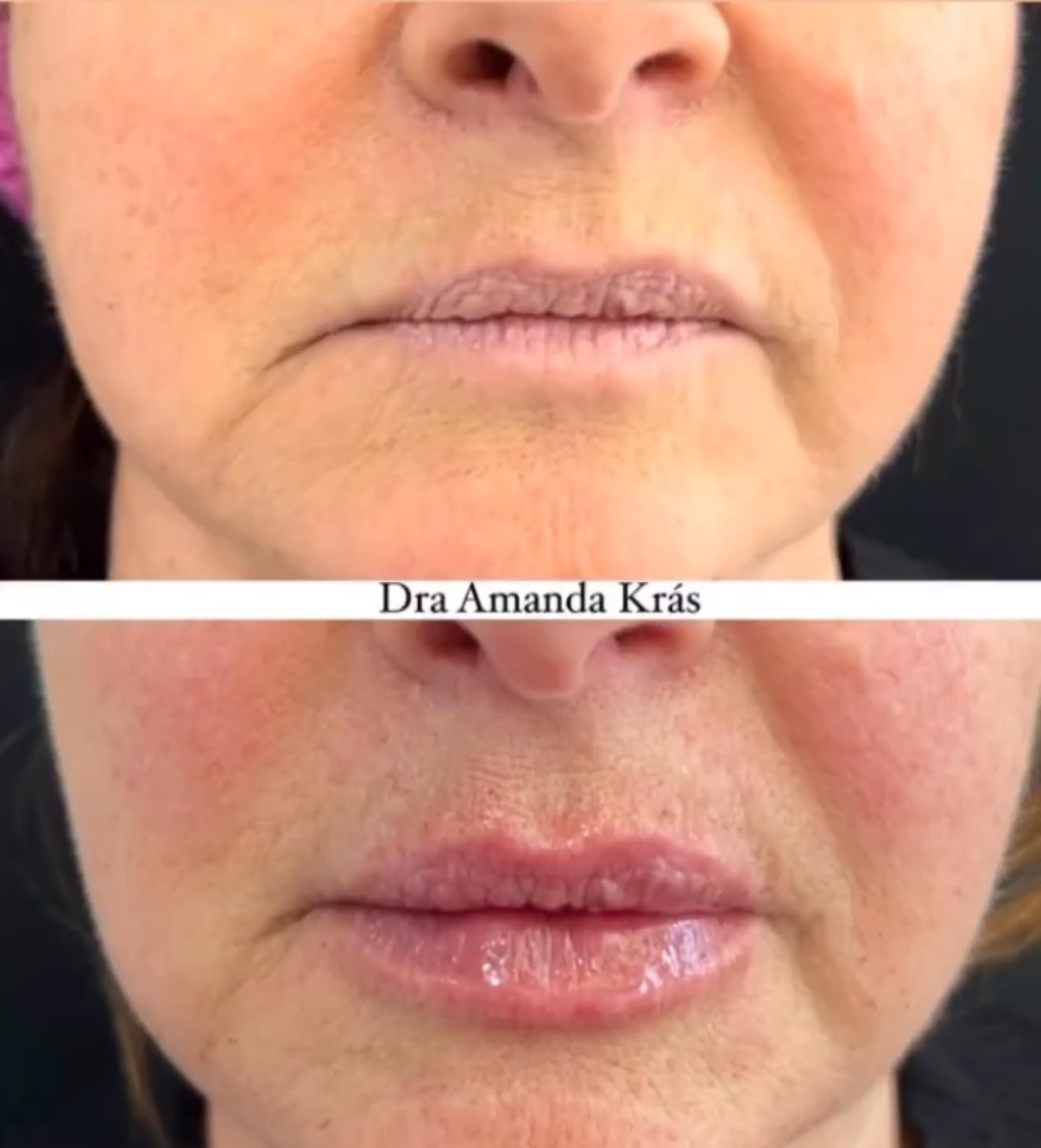 Preenchimento Labial Premium - Caso 1