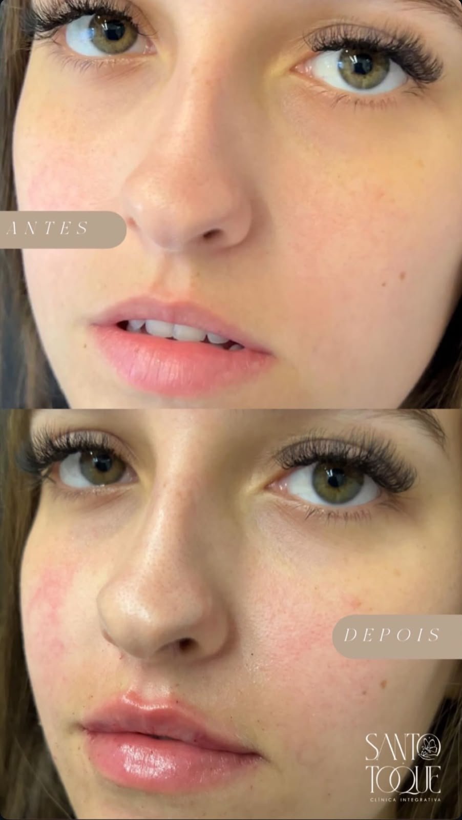 Preenchimento Labial Premium - Caso 2