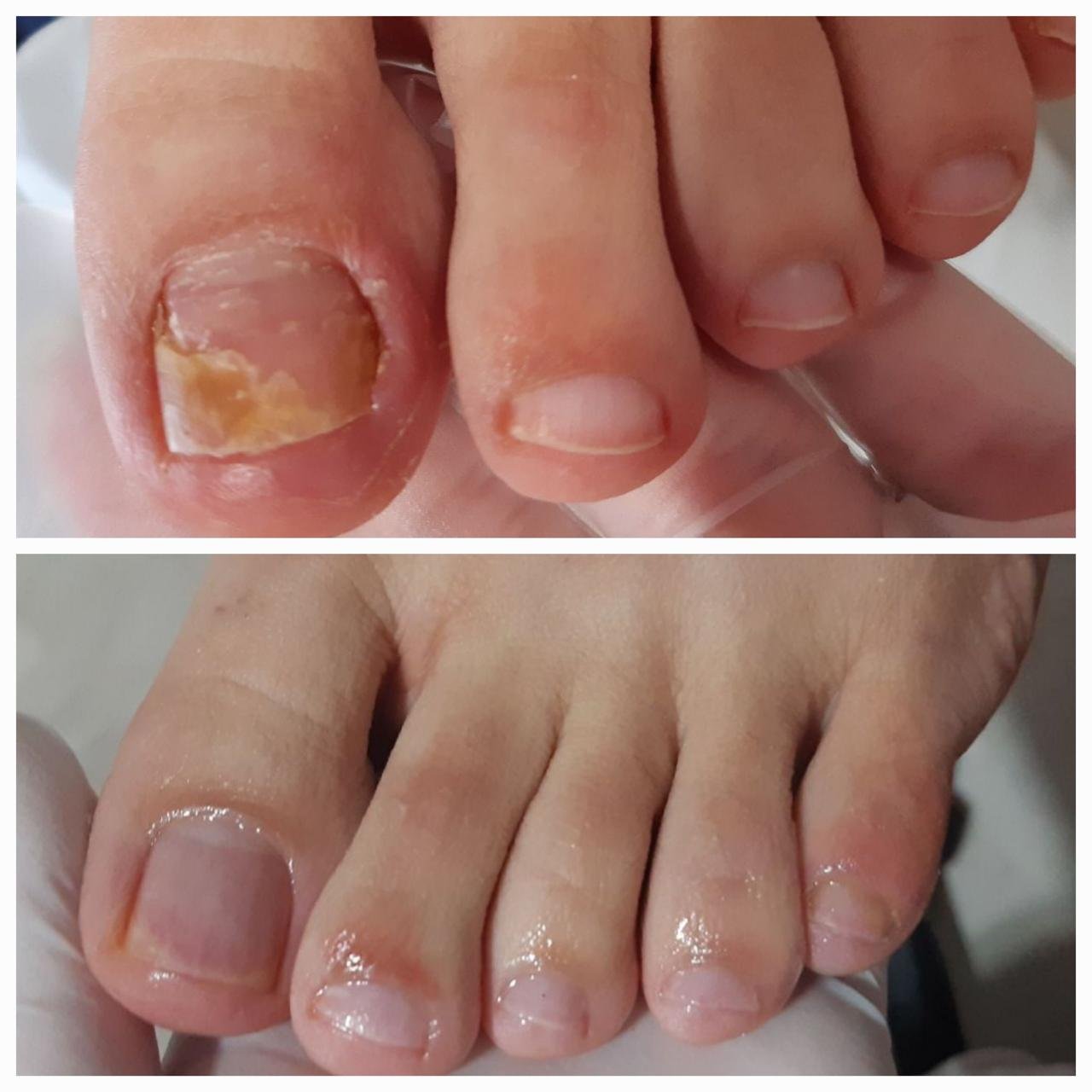 Antes e depois - Protocolo de Onicomicose