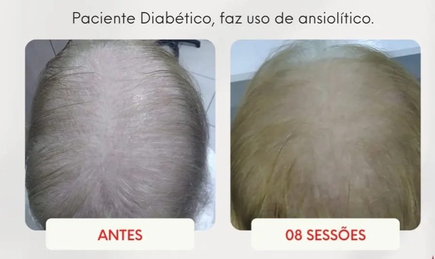 Paciente diabética, antes e depois de 8 sessões