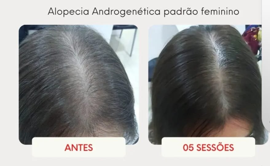 Alopecia androgenética padrão feminino, antes e depois de 5 sessões