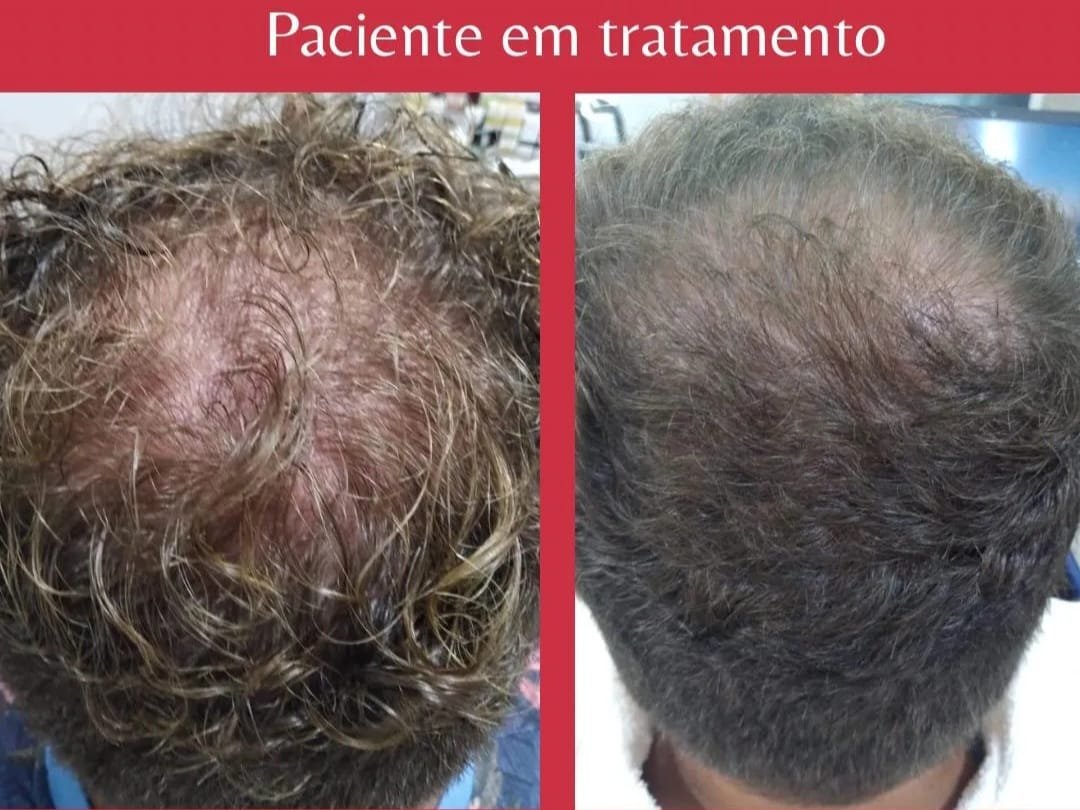Paciente em tratamento, antes e depois