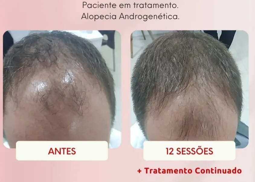Alopecia androgenética, antes e depois de 12 sessões