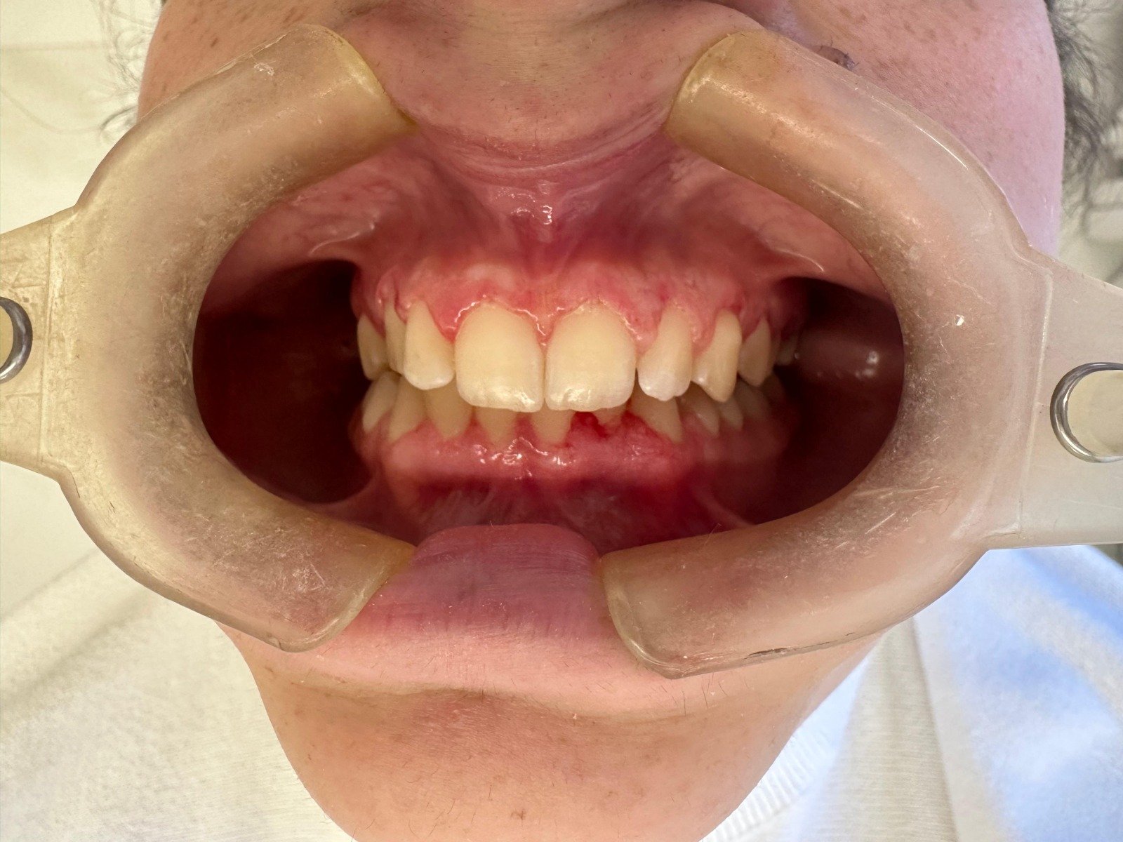Gengivoplastia - antes