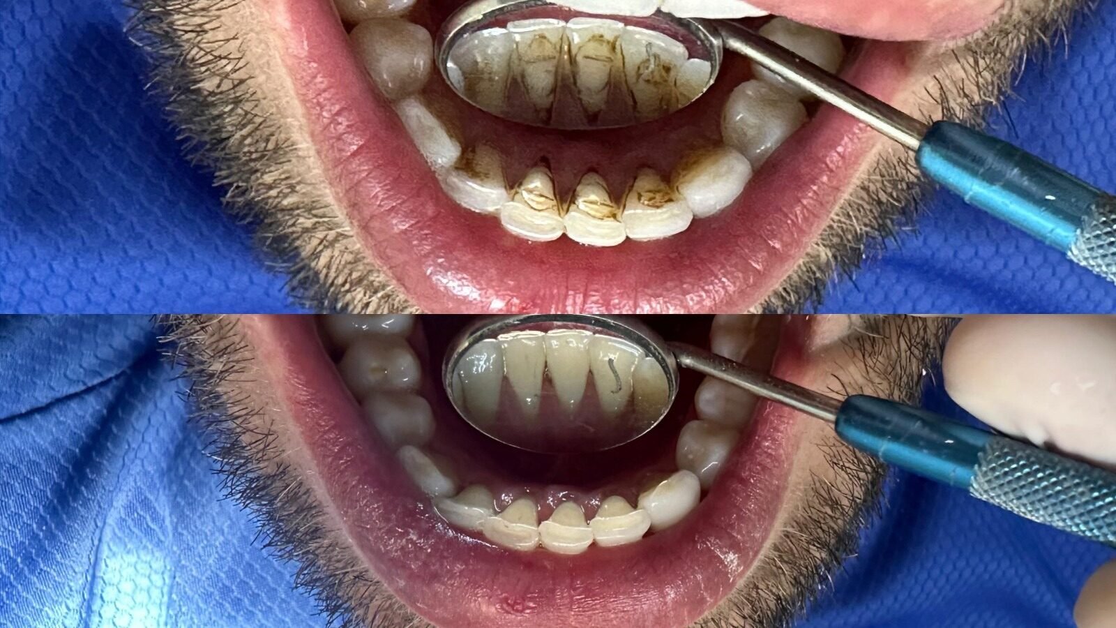 Limpeza dentária - antes e depois